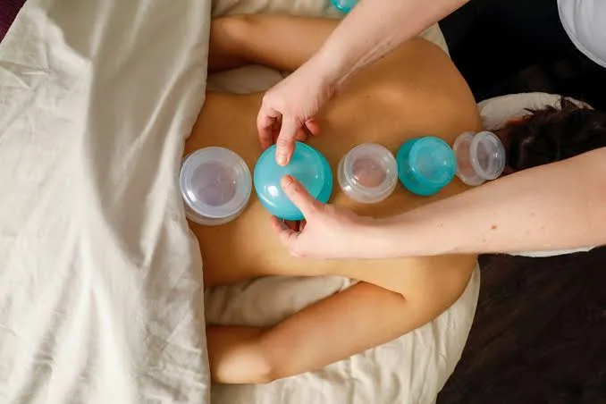 cupping therapy